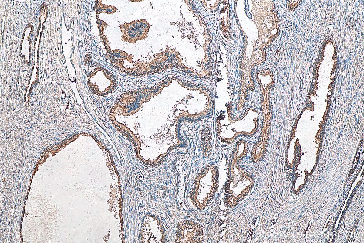 Immunohistochemistry (IHC) staining of human prostate cancer tissue using MST1 Polyclonal antibody (22245-1-AP)
