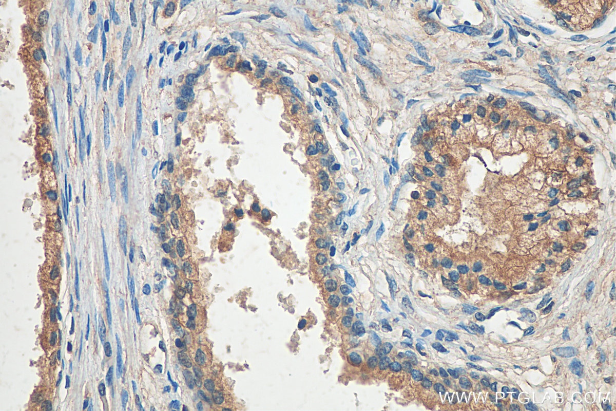 IHC staining of human prostate cancer using 22245-1-AP