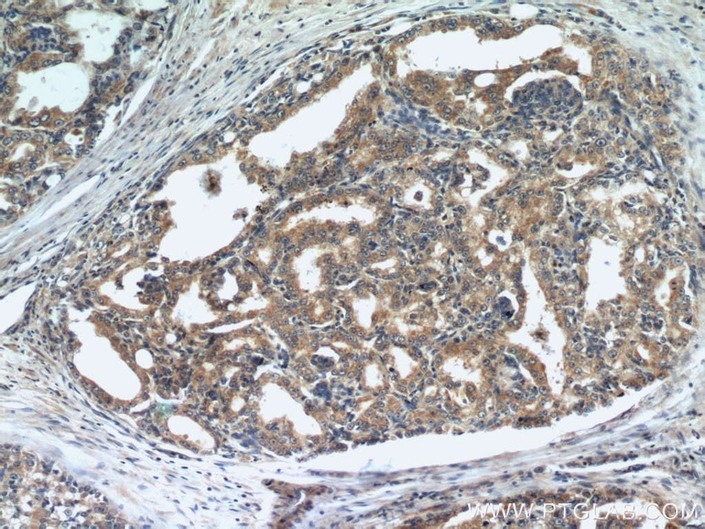 IHC staining of human prostate cancer using 22245-1-AP