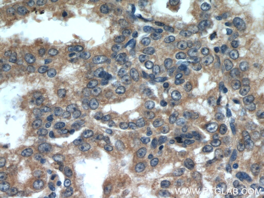 IHC staining of human prostate cancer using 22245-1-AP