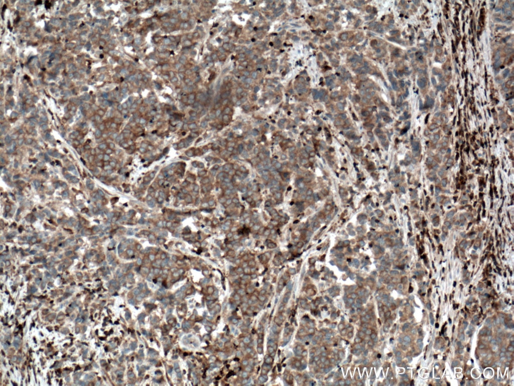 Immunohistochemistry (IHC) staining of human prostate cancer tissue using MST1 Monoclonal antibody (66663-1-Ig)