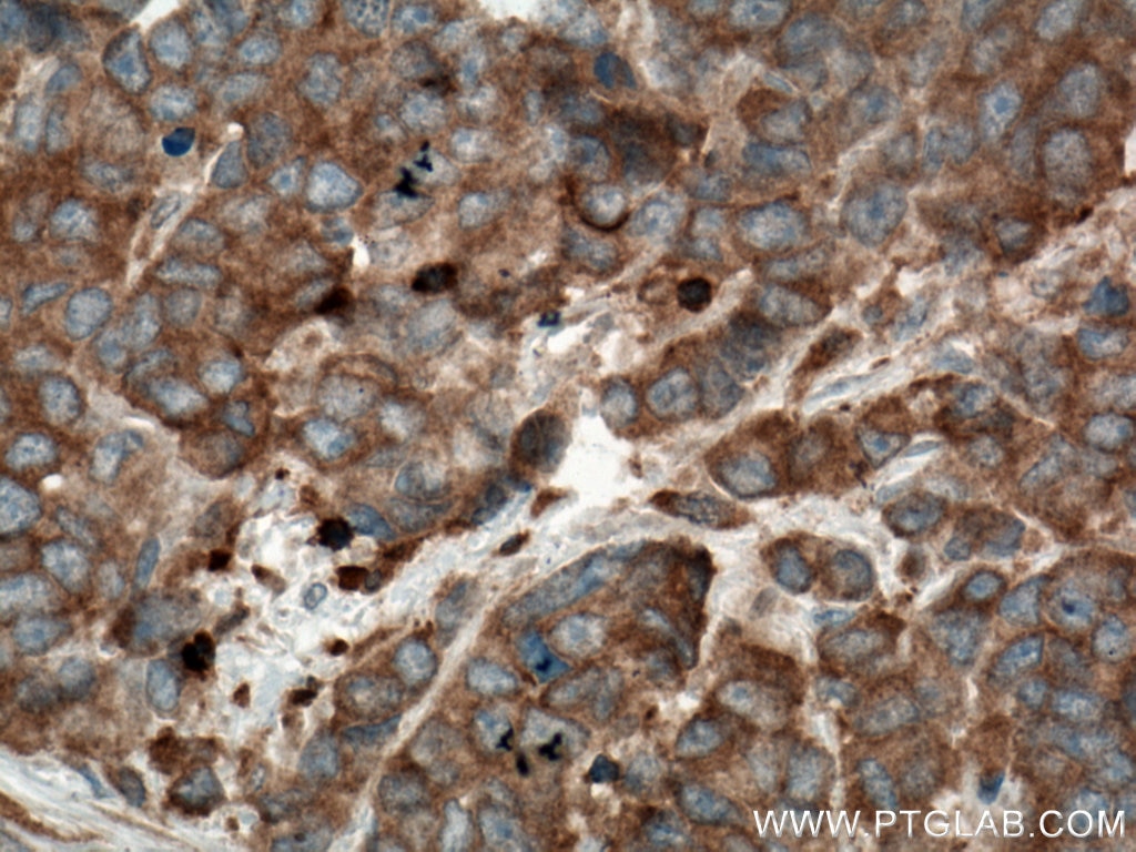 Immunohistochemistry (IHC) staining of human prostate cancer tissue using MST1 Monoclonal antibody (66663-1-Ig)