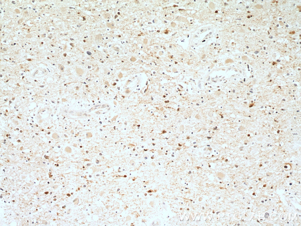 Immunohistochemistry (IHC) staining of human gliomas tissue using Stathmin 1 Polyclonal antibody (11157-1-AP)