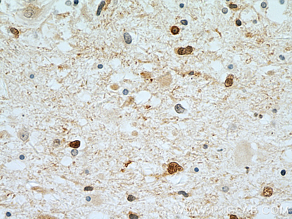Immunohistochemistry (IHC) staining of human gliomas tissue using Stathmin 1 Polyclonal antibody (11157-1-AP)