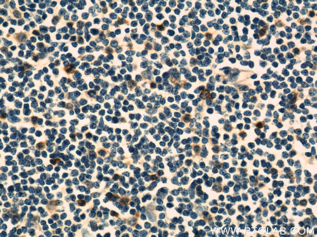 Immunohistochemistry (IHC) staining of human lymphoma tissue using Stathmin 1 Polyclonal antibody (11157-1-AP)