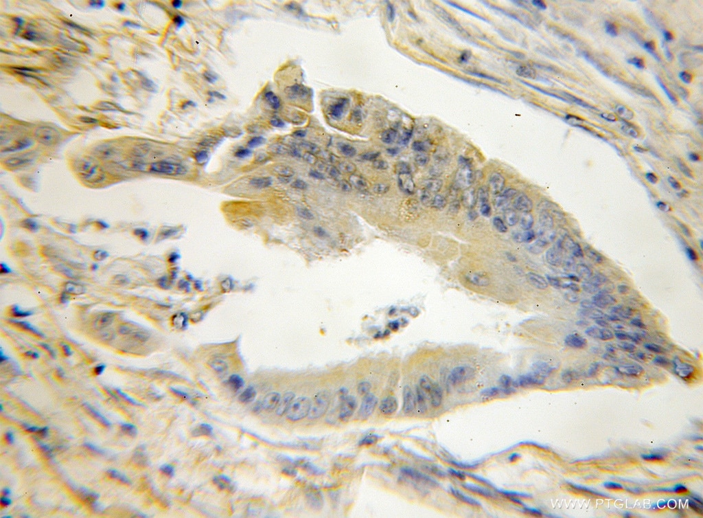 Immunohistochemistry (IHC) staining of human colon cancer tissue using STMN3 Polyclonal antibody (11311-1-AP)