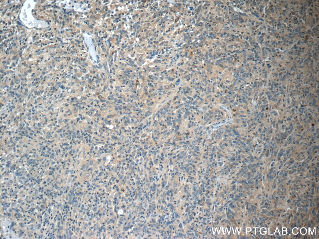 Immunohistochemistry (IHC) staining of human gliomas tissue using STMN4 Polyclonal antibody (12027-1-AP)