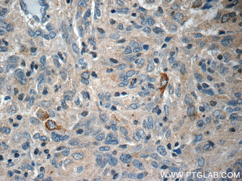 Immunohistochemistry (IHC) staining of human gliomas tissue using STMN4 Polyclonal antibody (12027-1-AP)