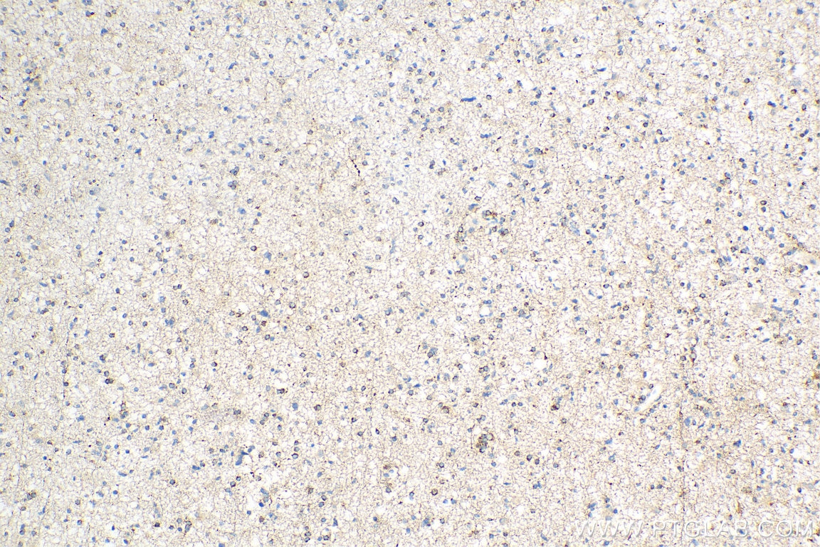 Immunohistochemistry (IHC) staining of human gliomas tissue using STMN4 Polyclonal antibody (12027-1-AP)