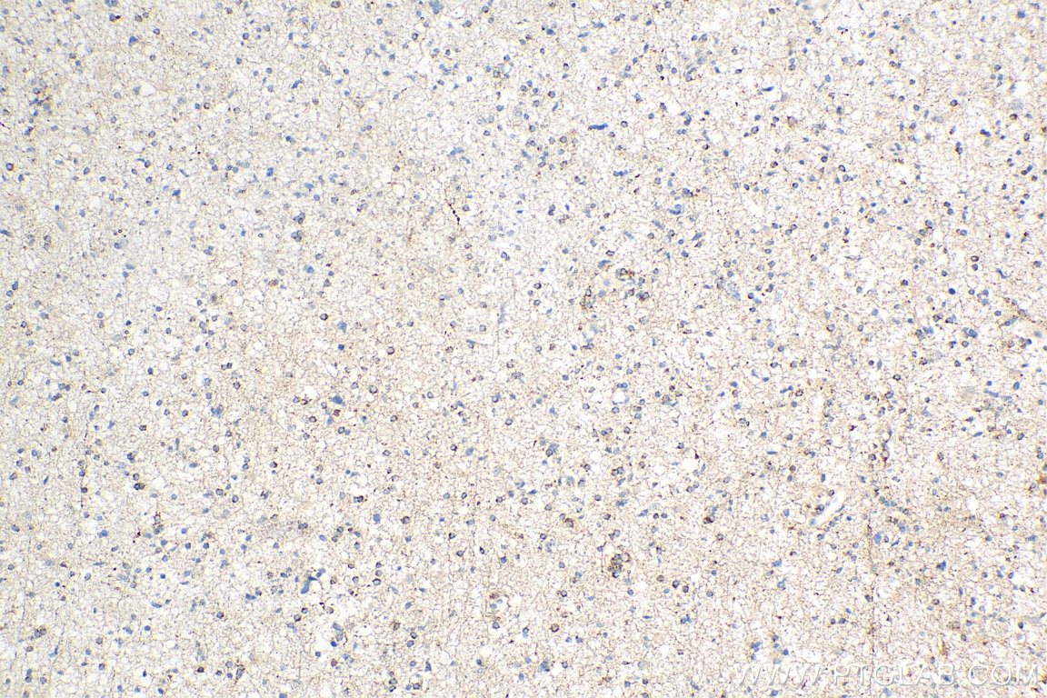 IHC staining of human gliomas using 12027-1-AP