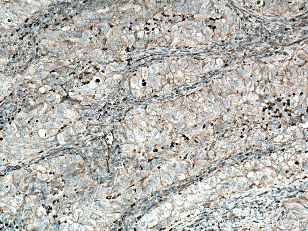 Immunohistochemistry (IHC) staining of human lung cancer tissue using Stomatin Polyclonal antibody (12046-1-AP)