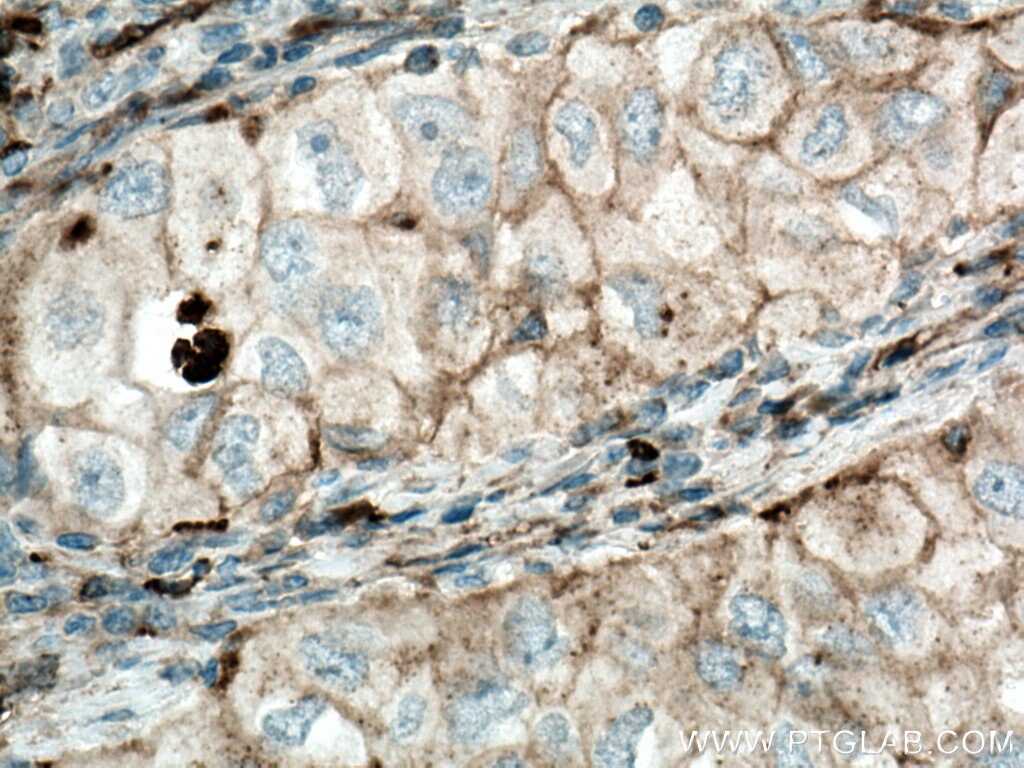 IHC staining of human lung cancer using 12046-1-AP