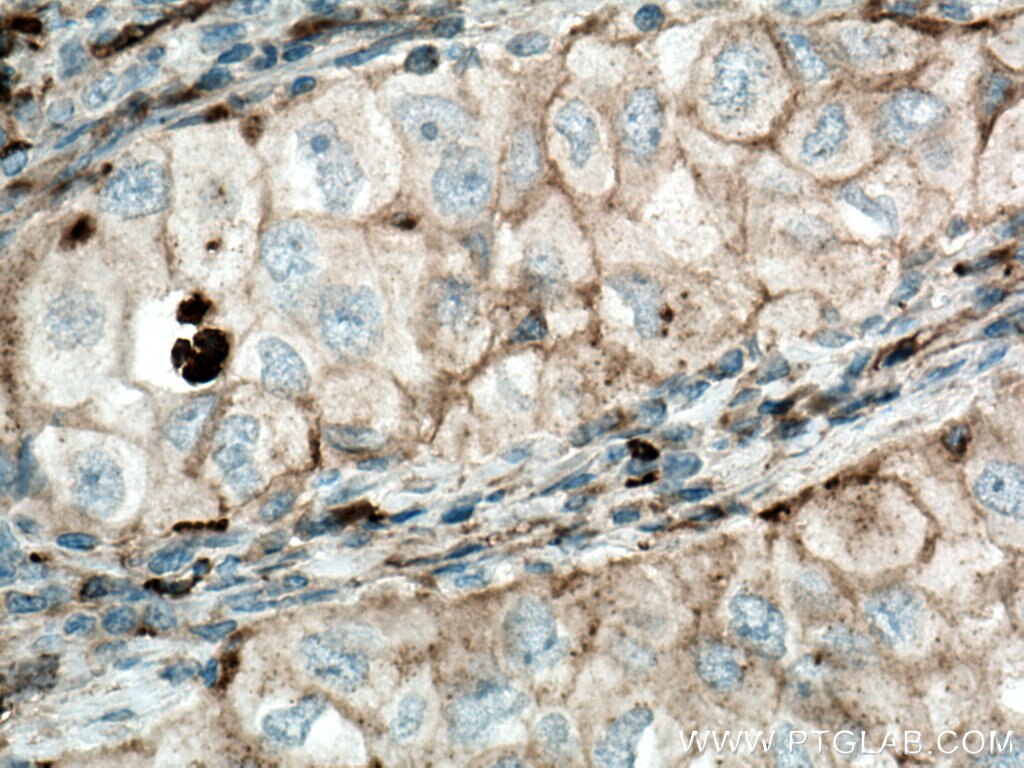 Immunohistochemistry (IHC) staining of human lung cancer tissue using Stomatin Polyclonal antibody (12046-1-AP)