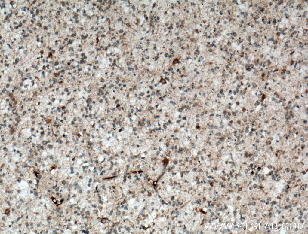 Immunohistochemistry (IHC) staining of human gliomas tissue using STOML1 Polyclonal antibody (12862-1-AP)