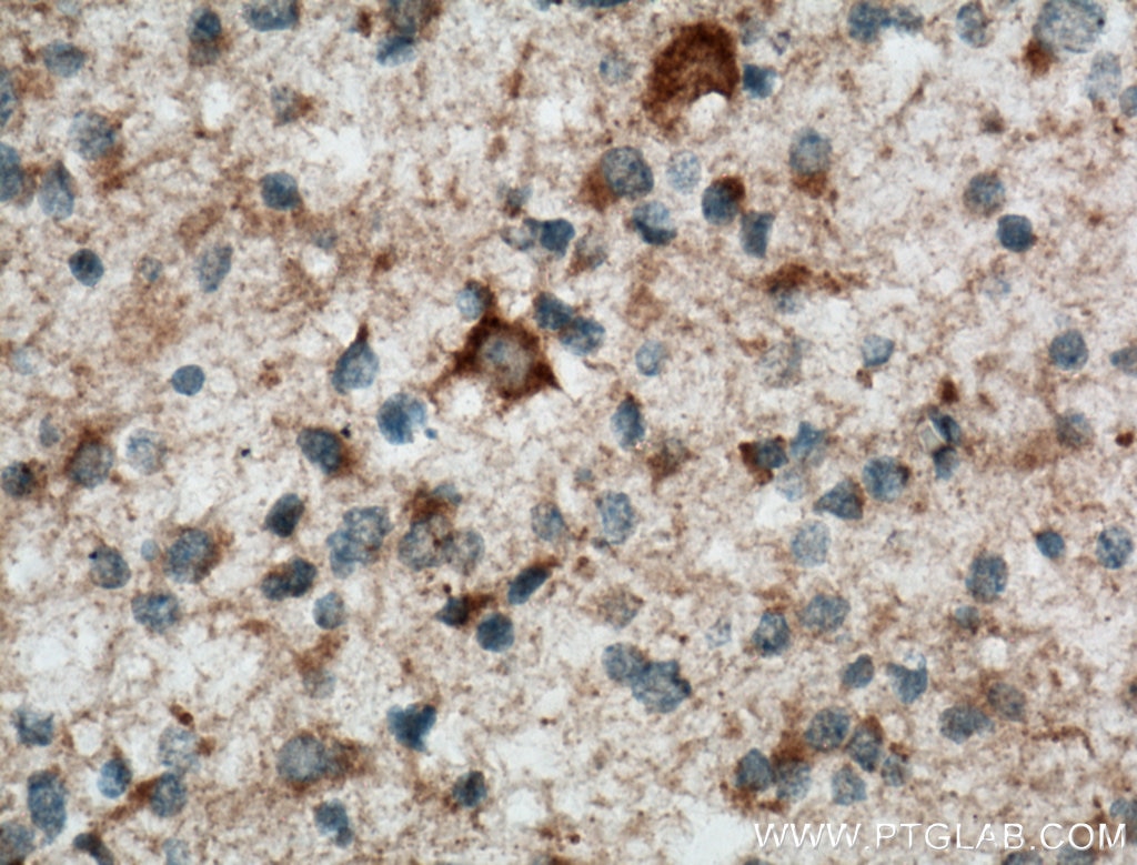 Immunohistochemistry (IHC) staining of human gliomas tissue using STOML1 Polyclonal antibody (12862-1-AP)