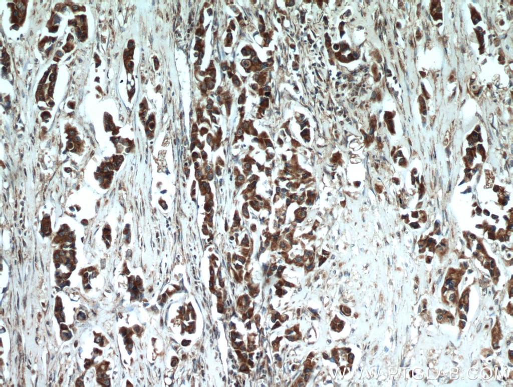 Immunohistochemistry (IHC) staining of human breast cancer tissue using STOML2 Polyclonal antibody (10348-1-AP)