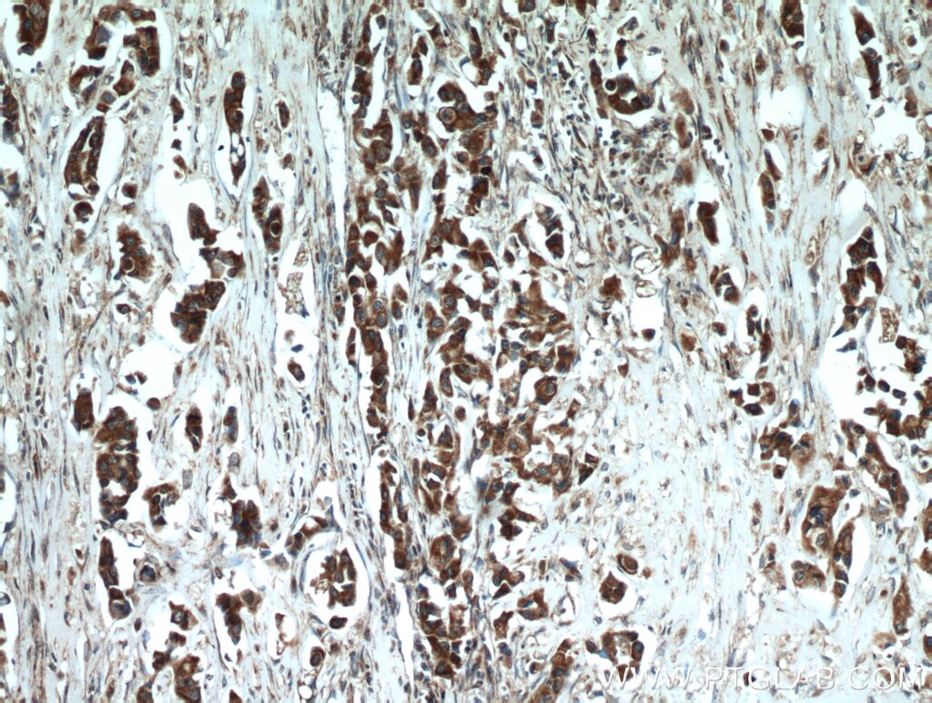 IHC staining of human breast cancer using 10348-1-AP