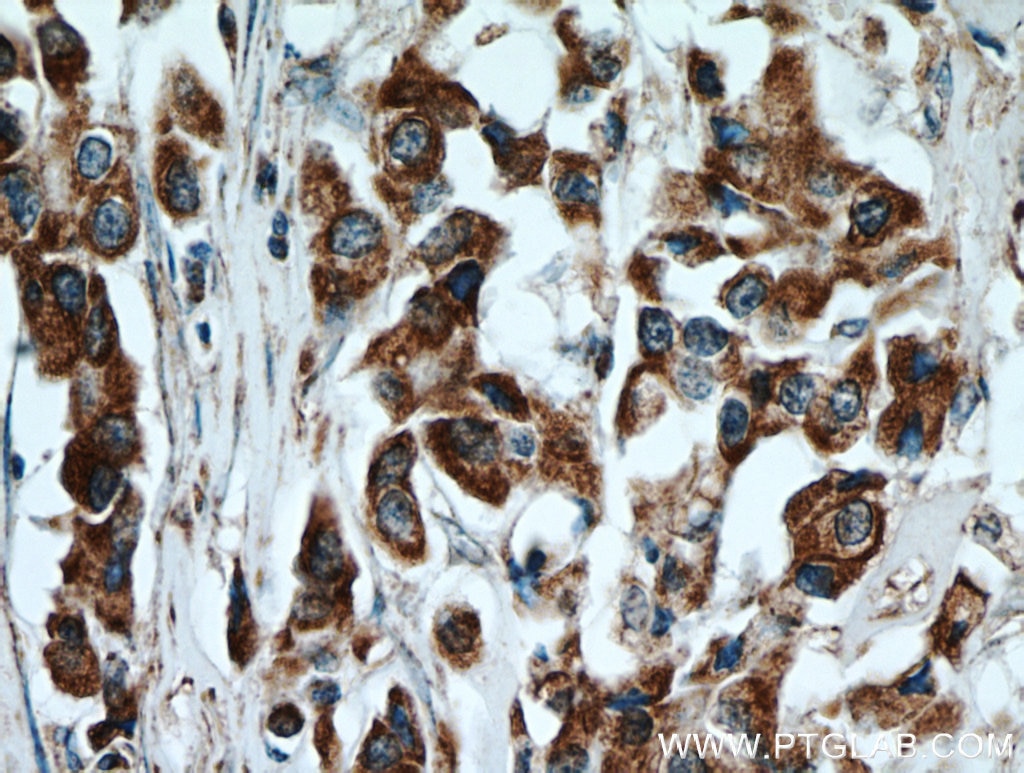 Immunohistochemistry (IHC) staining of human breast cancer tissue using STOML2 Polyclonal antibody (10348-1-AP)