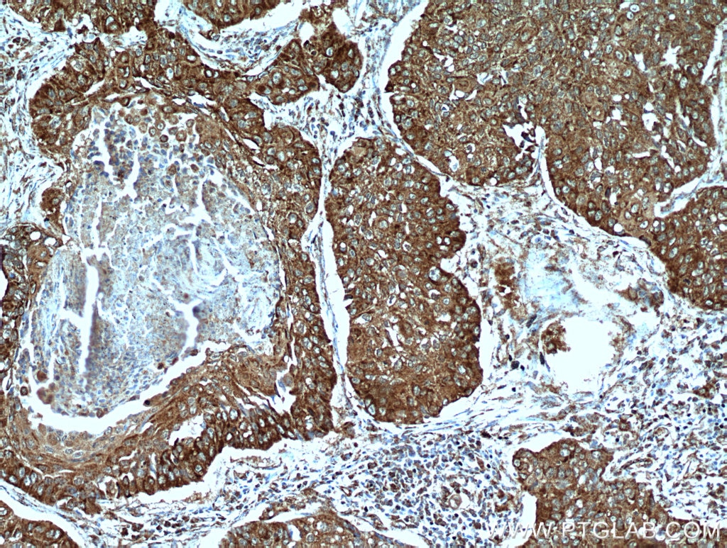 Immunohistochemistry (IHC) staining of human lung cancer tissue using STOML2 Polyclonal antibody (10348-1-AP)