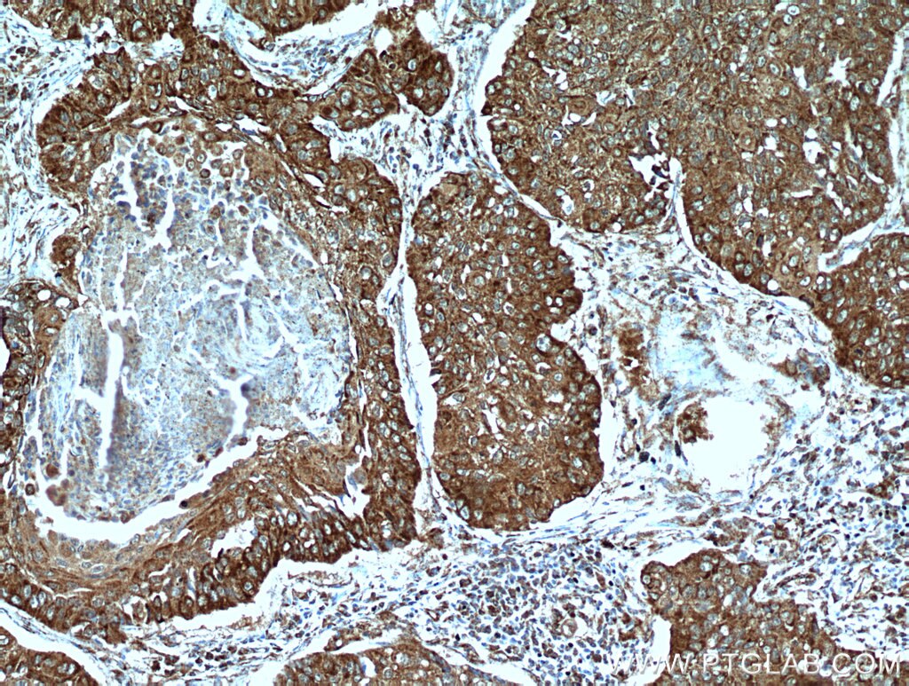 IHC staining of human lung cancer using 10348-1-AP