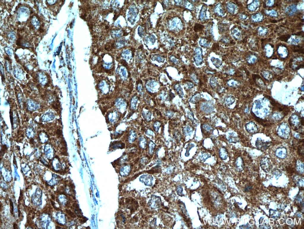 Immunohistochemistry (IHC) staining of human lung cancer tissue using STOML2 Polyclonal antibody (10348-1-AP)