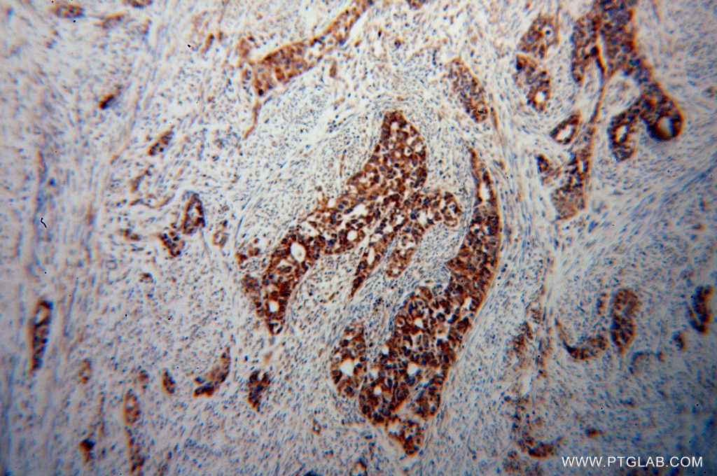 Immunohistochemistry (IHC) staining of human endometrial cancer tissue using STOML2 Polyclonal antibody (10348-1-AP)