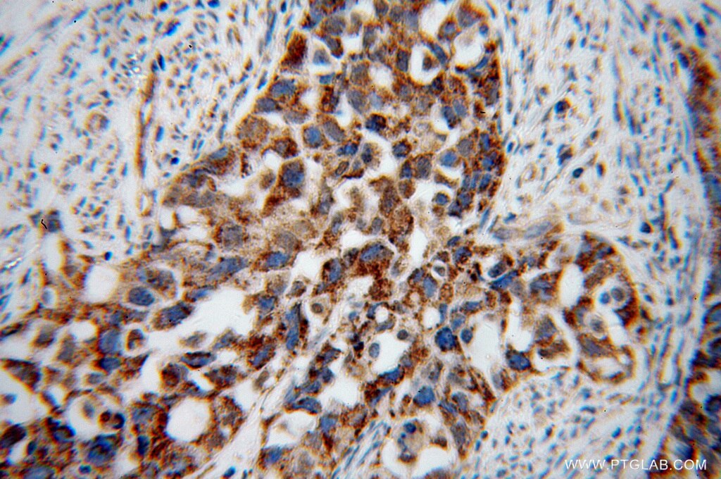 Immunohistochemistry (IHC) staining of human endometrial cancer tissue using STOML2 Polyclonal antibody (10348-1-AP)