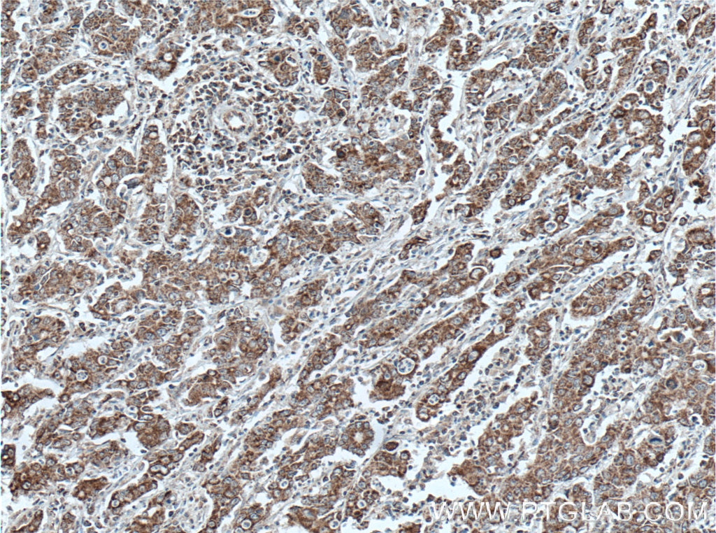Immunohistochemistry (IHC) staining of human stomach cancer tissue using STOML2 Monoclonal antibody (60052-1-Ig)