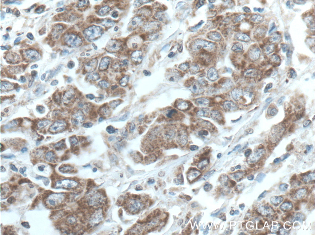 Immunohistochemistry (IHC) staining of human stomach cancer tissue using STOML2 Monoclonal antibody (60052-1-Ig)