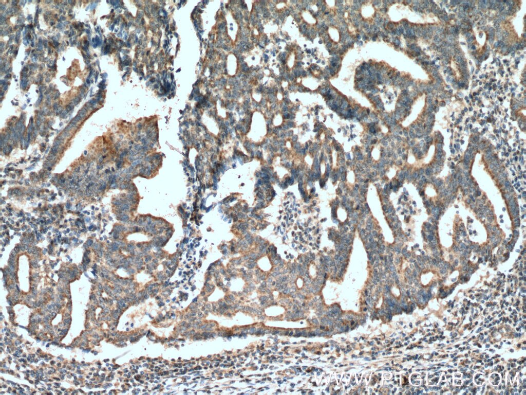 Immunohistochemistry (IHC) staining of human endometrial cancer tissue using STOML2 Monoclonal antibody (60052-1-Ig)