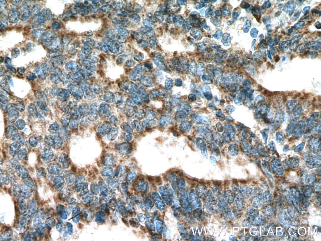 Immunohistochemistry (IHC) staining of human endometrial cancer tissue using STOML2 Monoclonal antibody (60052-1-Ig)