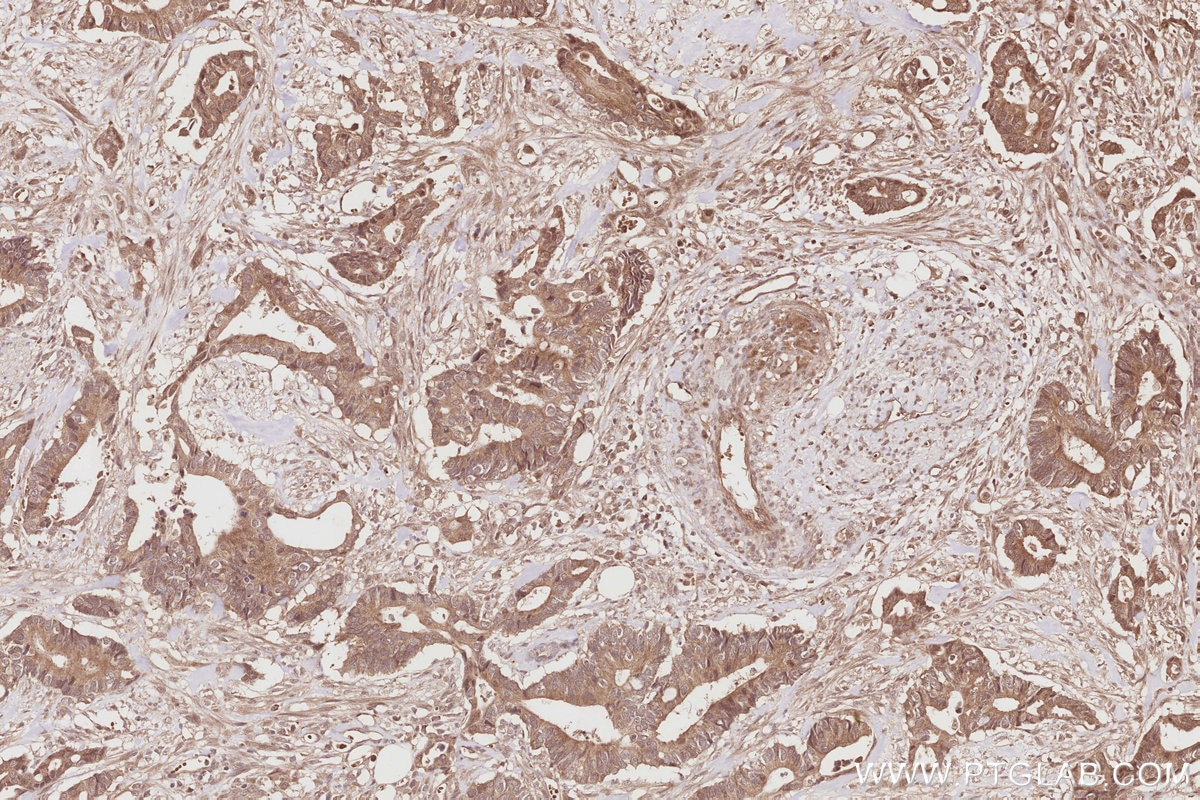 Immunohistochemistry (IHC) staining of human rectal cancer tissue using STRADB Polyclonal antibody (10688-1-AP)