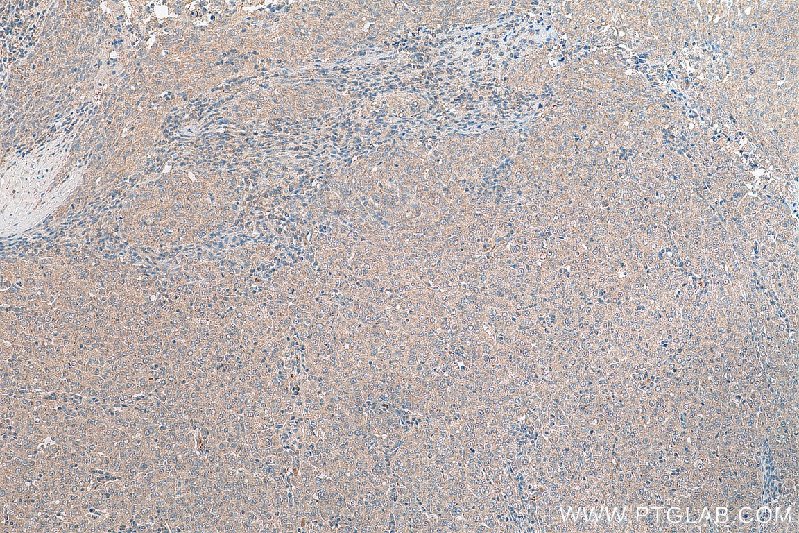 Immunohistochemistry (IHC) staining of human ovary tumor tissue using STRAP Polyclonal antibody (18277-1-AP)