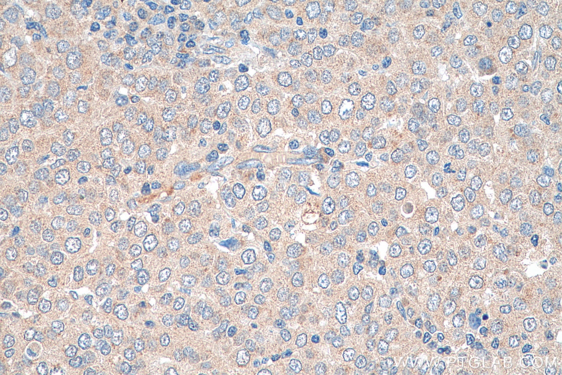 Immunohistochemistry (IHC) staining of human ovary tumor tissue using STRAP Polyclonal antibody (18277-1-AP)