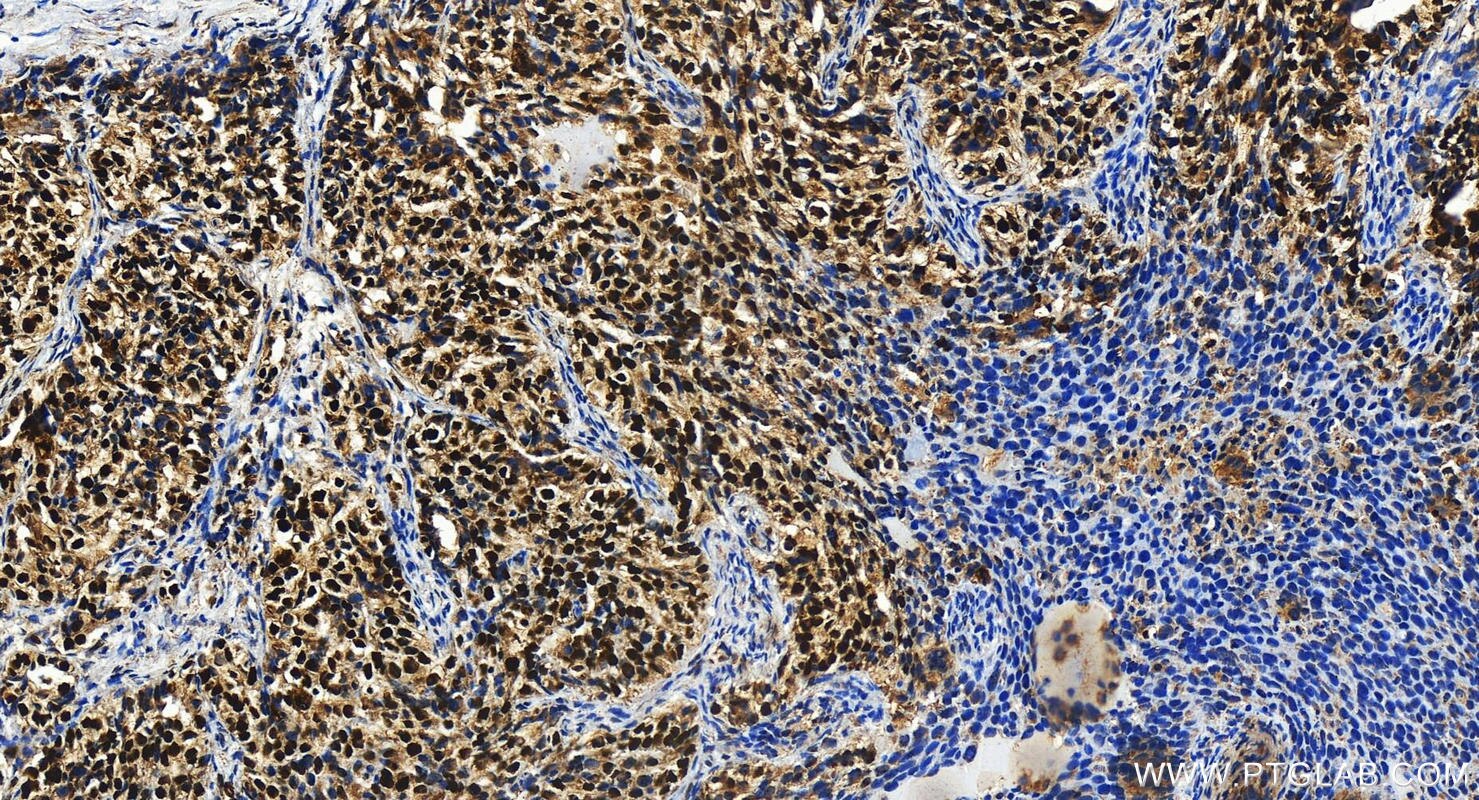 Immunohistochemistry (IHC) staining of human ovary cancer tissue using STRBP Polyclonal antibody (17362-1-AP)