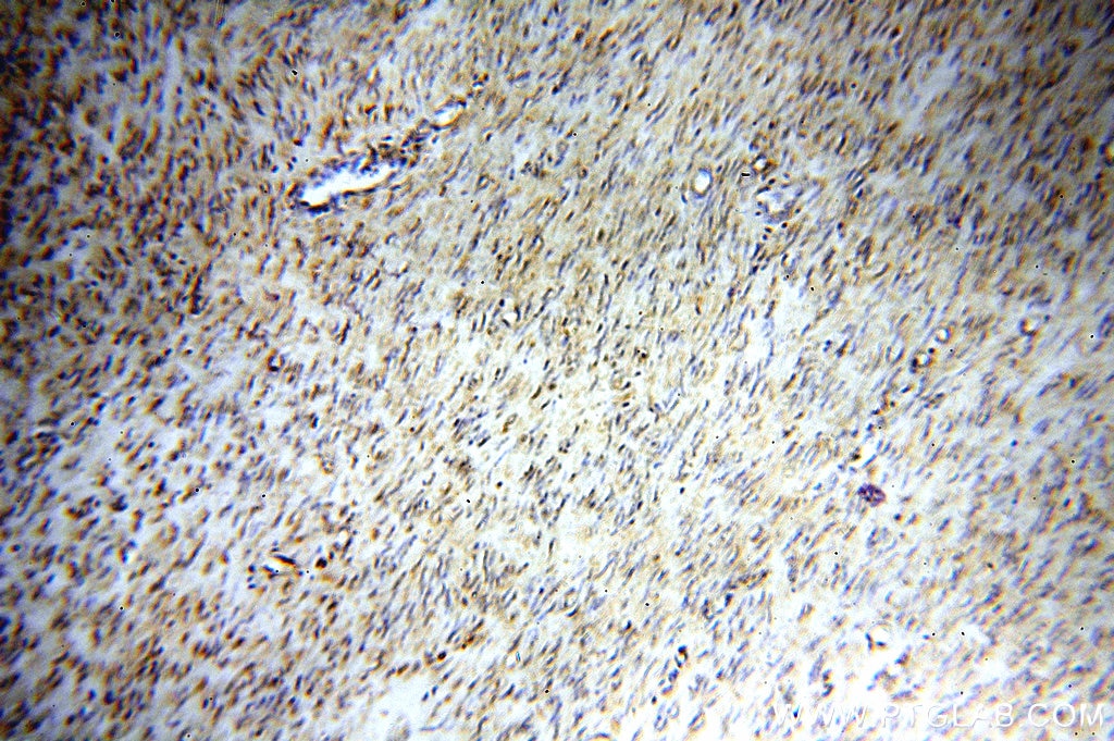 Immunohistochemistry (IHC) staining of human hysteromyoma tissue using STS Polyclonal antibody (17870-1-AP)