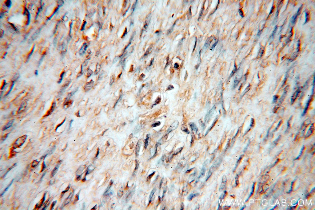 Immunohistochemistry (IHC) staining of human hysteromyoma tissue using STS Polyclonal antibody (17870-1-AP)