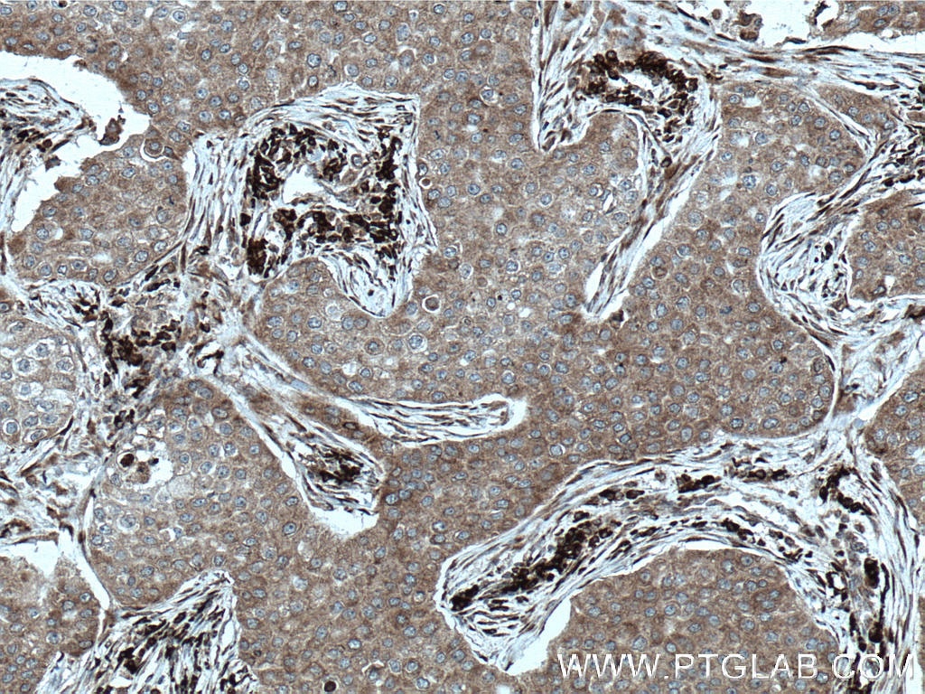 Immunohistochemistry (IHC) staining of human breast cancer tissue using STT3A Monoclonal antibody (66581-1-Ig)