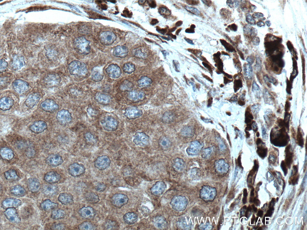 Immunohistochemistry (IHC) staining of human breast cancer tissue using STT3A Monoclonal antibody (66581-1-Ig)