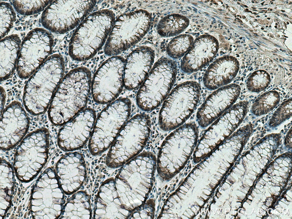 Immunohistochemistry (IHC) staining of human colon cancer tissue using STUB1 Polyclonal antibody (55430-1-AP)