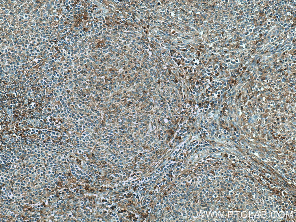 Immunohistochemistry (IHC) staining of human lymphoma tissue using Syntaxin 11 Polyclonal antibody (13301-1-AP)