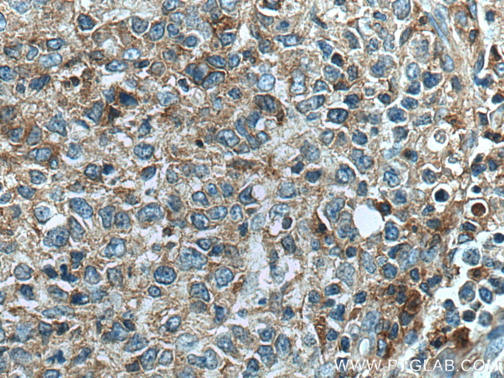 Immunohistochemistry (IHC) staining of human lymphoma tissue using Syntaxin 11 Polyclonal antibody (13301-1-AP)