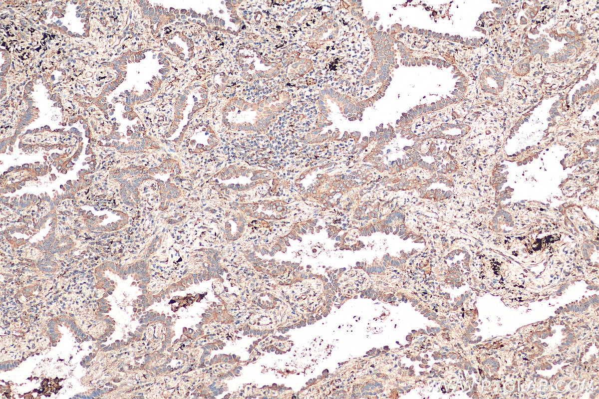 Immunohistochemistry (IHC) staining of human lung cancer tissue using Syntaxin 12 Polyclonal antibody (14259-1-AP)