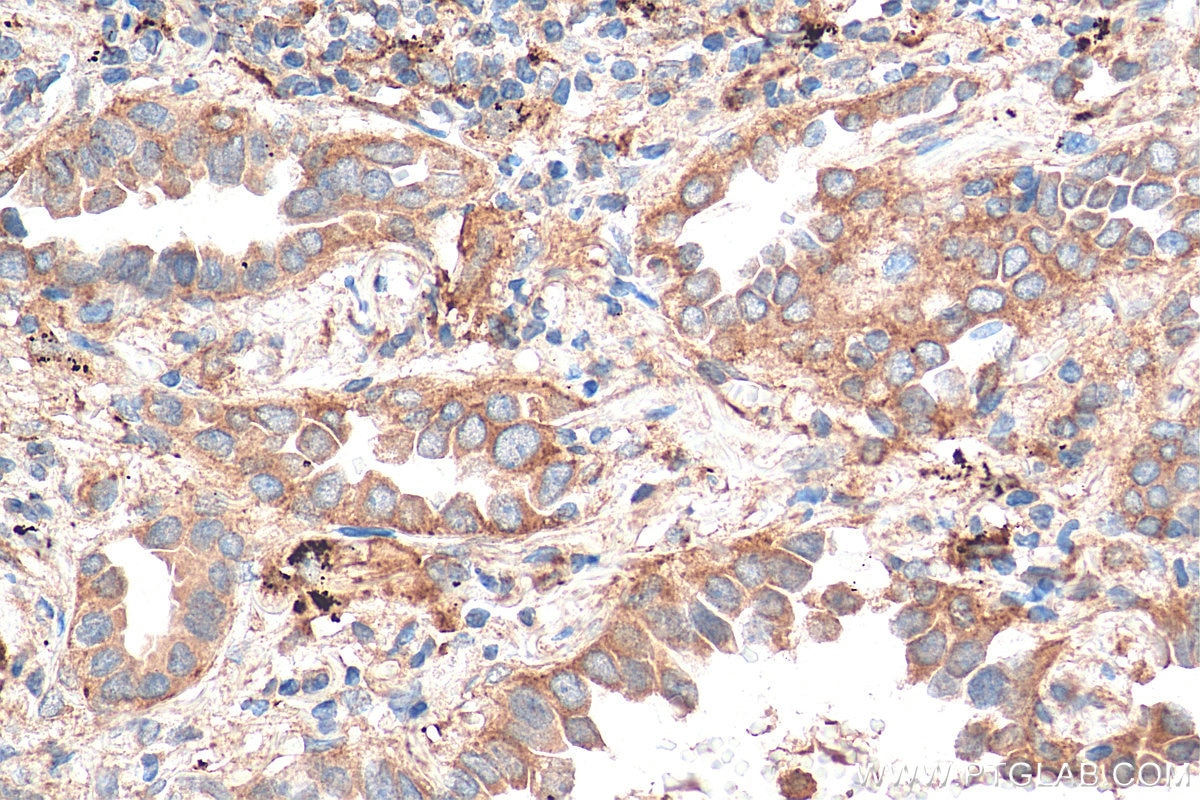Immunohistochemistry (IHC) staining of human lung cancer tissue using Syntaxin 12 Polyclonal antibody (14259-1-AP)