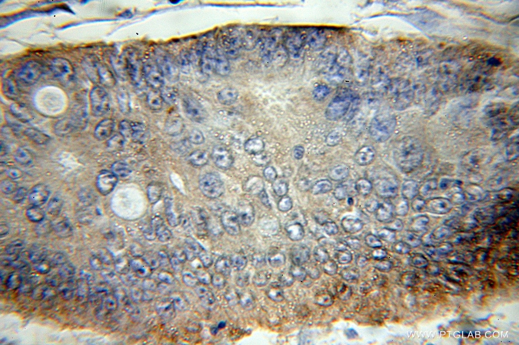 Immunohistochemistry (IHC) staining of human colon cancer tissue using Syntaxin 16 Polyclonal antibody (11201-1-AP)