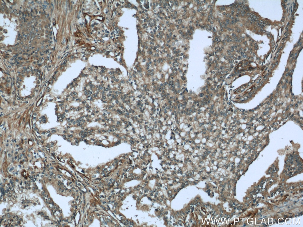 Immunohistochemistry (IHC) staining of human prostate cancer tissue using Syntaxin 6 Polyclonal antibody (10841-1-AP)