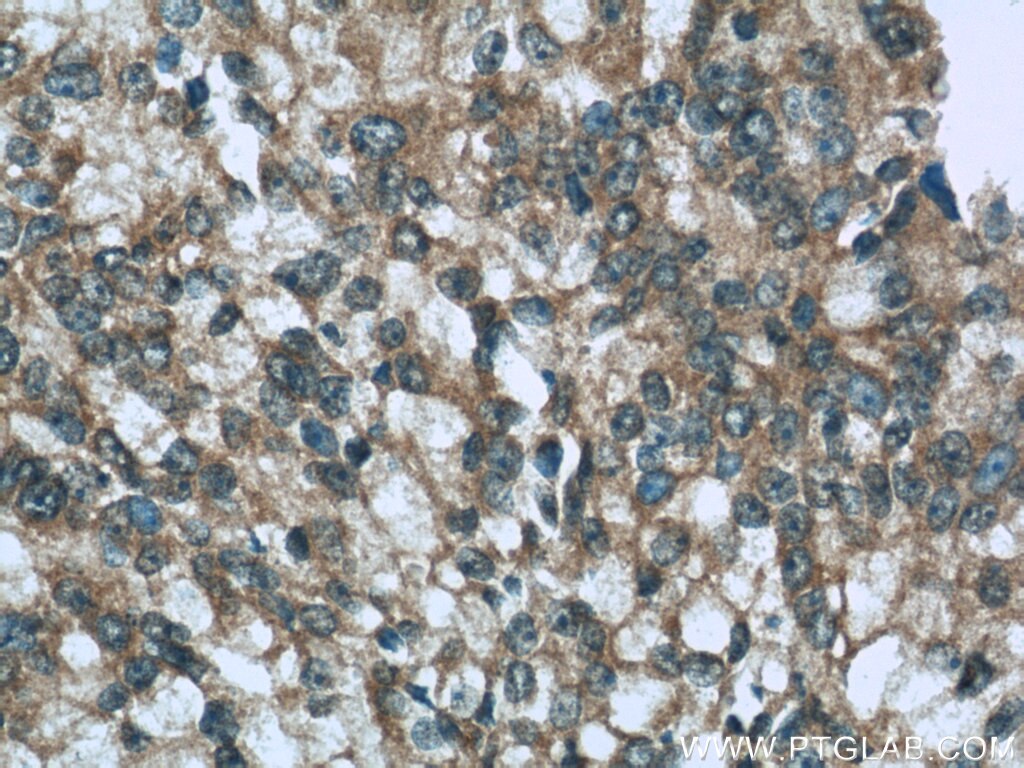 Immunohistochemistry (IHC) staining of human prostate cancer tissue using Syntaxin 6 Polyclonal antibody (10841-1-AP)