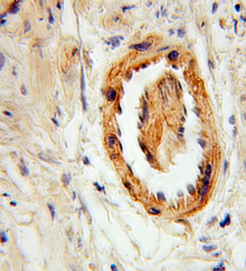 Immunohistochemistry (IHC) staining of human prostate cancer tissue using Syntaxin 6 Polyclonal antibody (10841-1-AP)