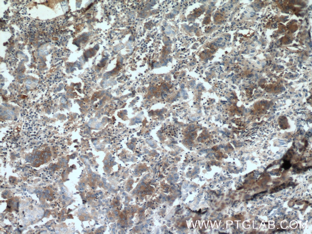 Immunohistochemistry (IHC) staining of human prostate cancer tissue using Syntaxin 6 Monoclonal antibody (60059-1-Ig)