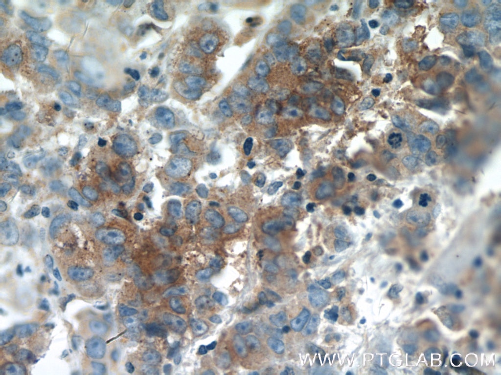 Immunohistochemistry (IHC) staining of human prostate cancer tissue using Syntaxin 6 Monoclonal antibody (60059-1-Ig)